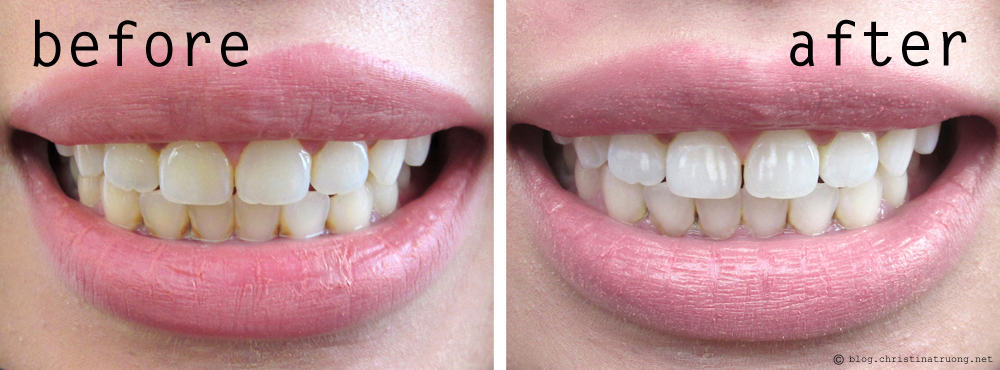 Smile Brilliant Teeth Whitening First Impression Review Before and After